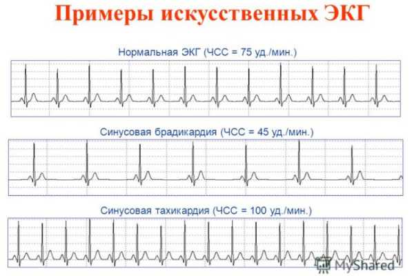 Экг описание норма образец